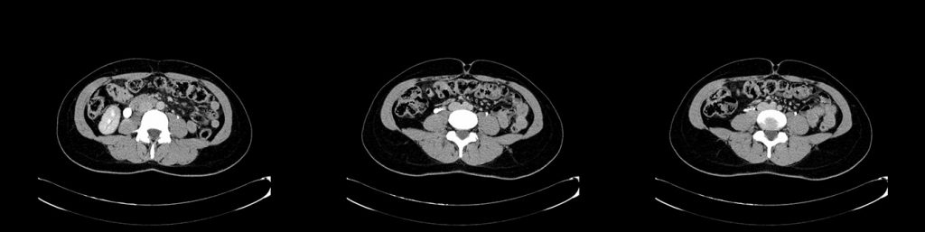 Figura 6.50, 6.51 y 6.52: TAC que muestra la estenosis de uréter a nivel lumbar por cruces venosos de ramas de la vena ovárica.
