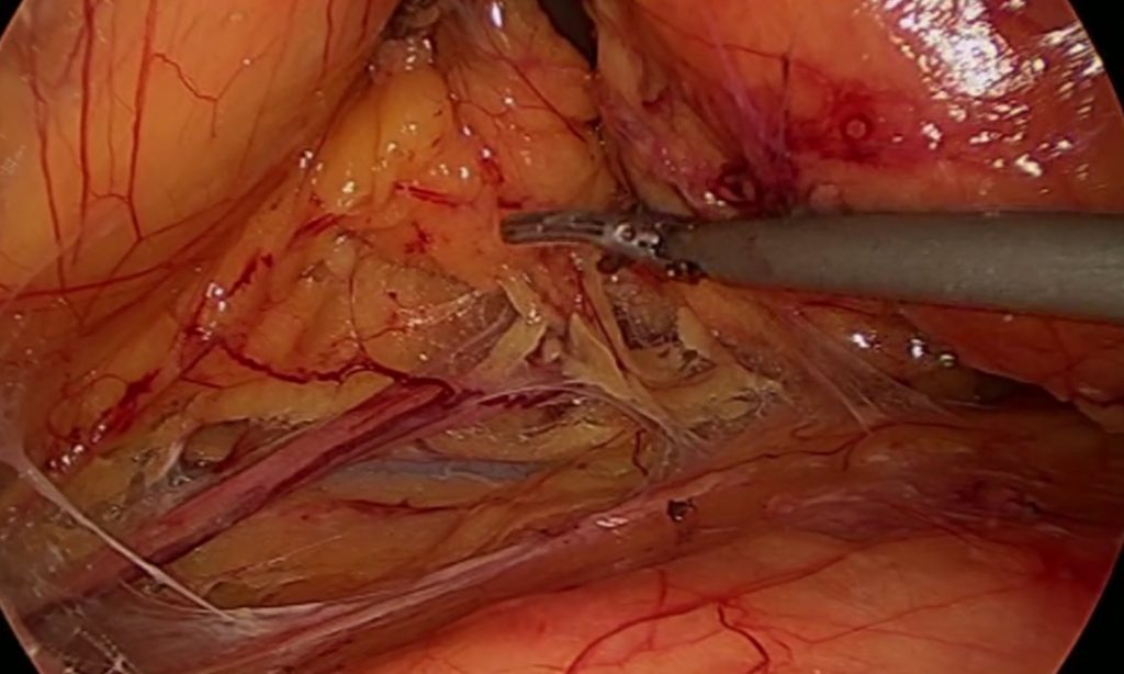 Figura 21: Visón del uréter y la vena gonadal